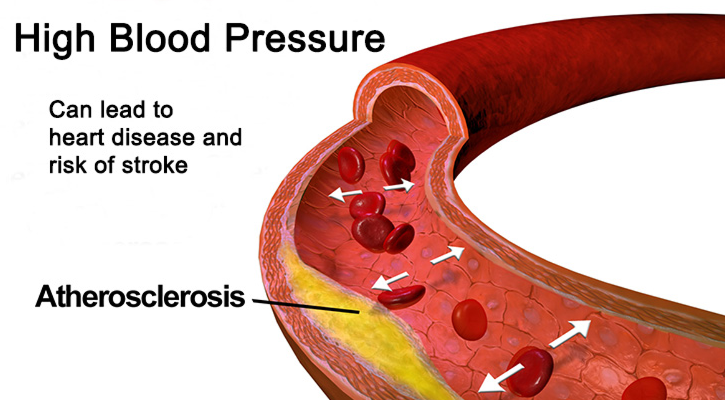 What Causes High Blood Pressure