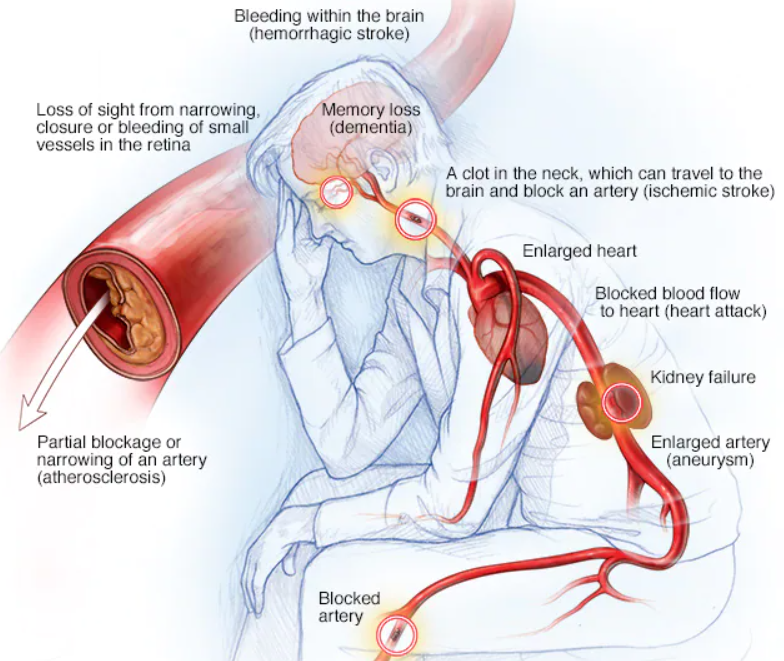 What Is High Blood Pressure